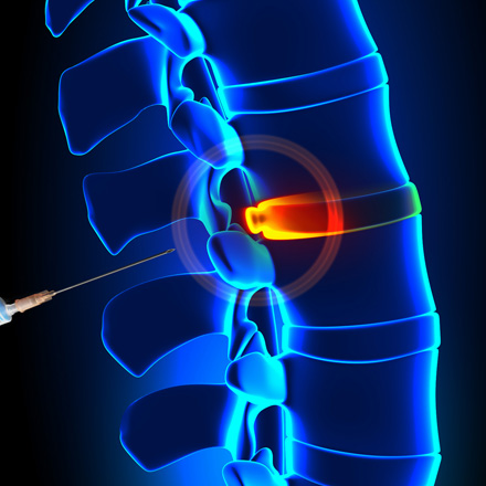 imagerie interventionnelle-infiltration